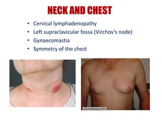 NECK AND CHEST
• Cervical lymphadenopathy
• Left supraclavicular fossa (Virchov’s node)
• Gynaecomastia
• Symmetry of the chest
 