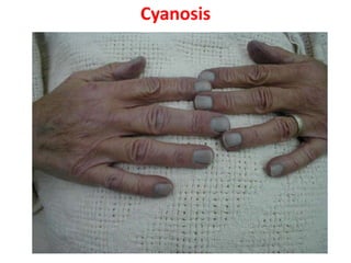 Cyanosis
 