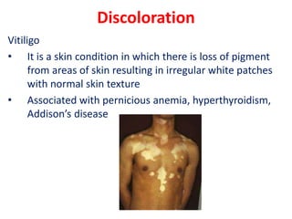 Discoloration
Vitiligo
• It is a skin condition in which there is loss of pigment
from areas of skin resulting in irregular white patches
with normal skin texture
• Associated with pernicious anemia, hyperthyroidism,
Addison’s disease
 