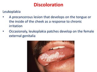 Discoloration
Leukoplakia
• A precancerous lesion that develops on the tongue or
the inside of the cheek as a response to chronic
irritation
• Occasionaly, leukoplakia patches develop on the female
external genitalia
 