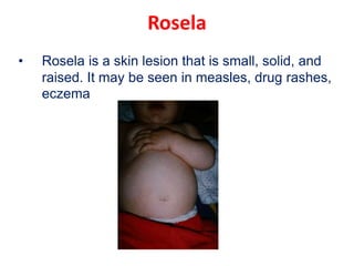 Rosela
• Rosela is a skin lesion that is small, solid, and
raised. It may be seen in measles, drug rashes,
eczema
 