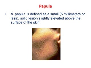 Papule
• A papule is defined as a small (5 millimeters or
less), solid lesion slightly elevated above the
surface of the skin.
 