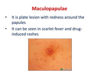 Maculopapulae
• It is plate lesion with redness around the
papules
• It can be seen in scarlet fever and drug-
induced rashes
 