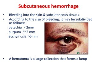 Subcutaneous hemorrhage
• Bleeding into the skin & subcutaneous tissues
• According to the size of bleeding, it may be subdivided
as follows:
petechia <2mm
purpura 3~5 mm
ecchymosis >5mm
• A hematoma is a large collection that forms a lump
 