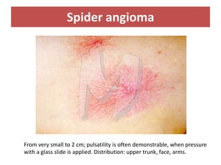 Spider angioma
From very small to 2 cm; pulsatility is often demonstrable, when pressure
with a glass slide is applied. Distribution: upper trunk, face, arms.
 