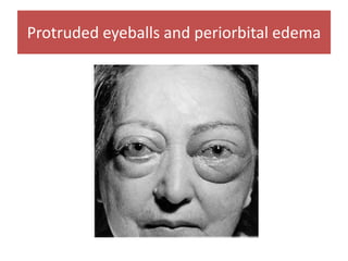 Protruded eyeballs and periorbital edema
 