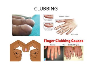 Clubbing Pathophysiology Notes general examination.pptx