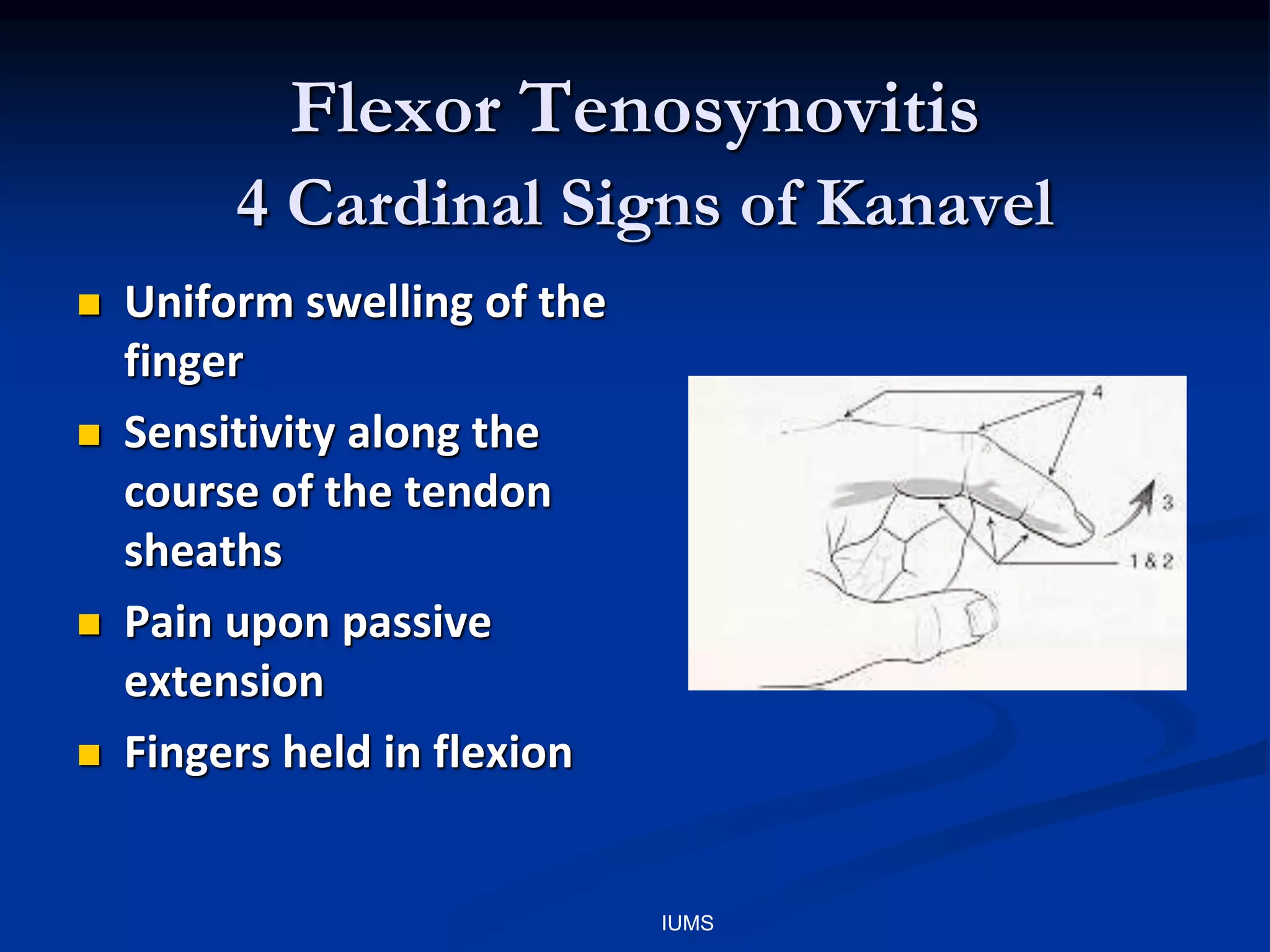 Flexor Tenosynovitis
4 Cardinal Signs of Kanavel
 Uniform swelling of the
finger
 Sensitivity along the
course of the tendon
sheaths
 Pain upon passive
extension
 Fingers held in flexion
IUMS
 