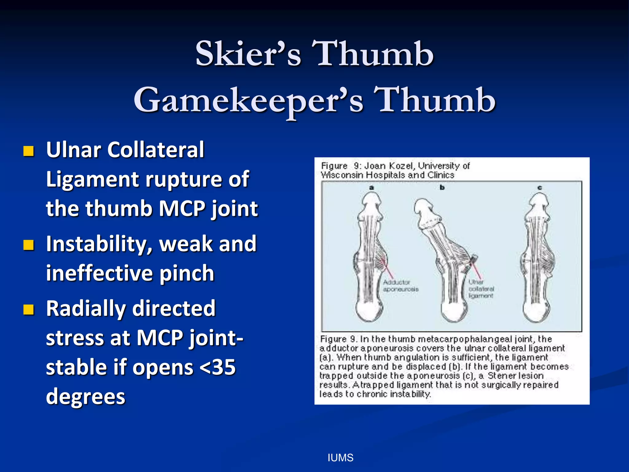Skier’s Thumb
Gamekeeper’s Thumb
 Ulnar Collateral
Ligament rupture of
the thumb MCP joint
 Instability, weak and
ineffective pinch
 Radially directed
stress at MCP joint-
stable if opens <35
degrees
IUMS
 