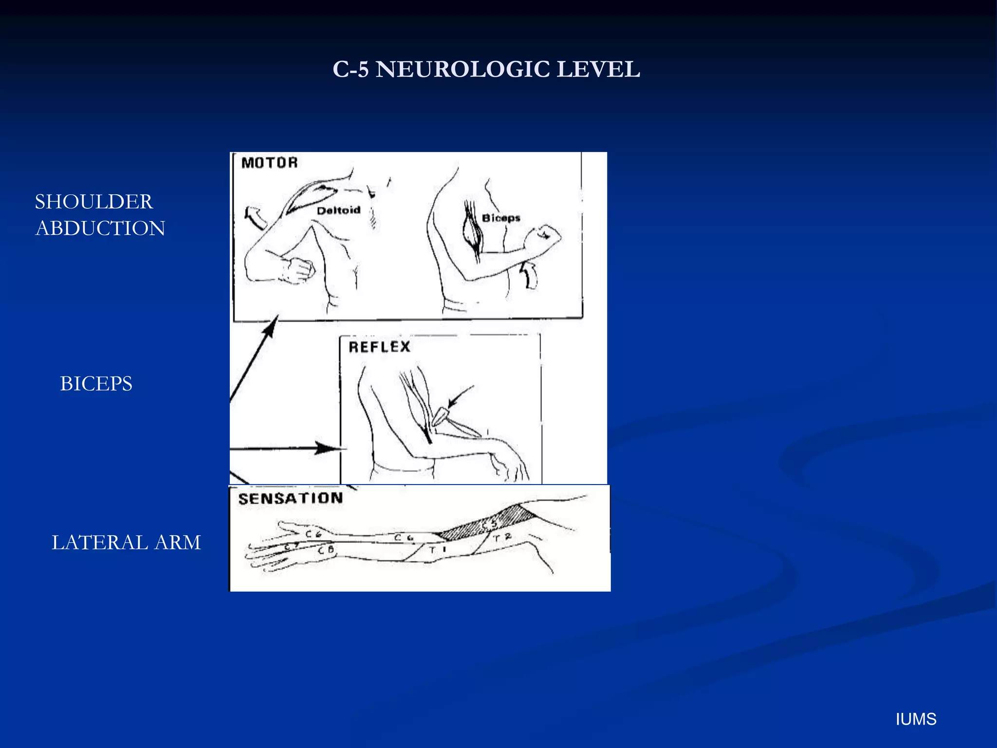 C-5 NEUROLOGIC LEVEL
SHOULDER
ABDUCTION
BICEPS
LATERAL ARM
IUMS
 