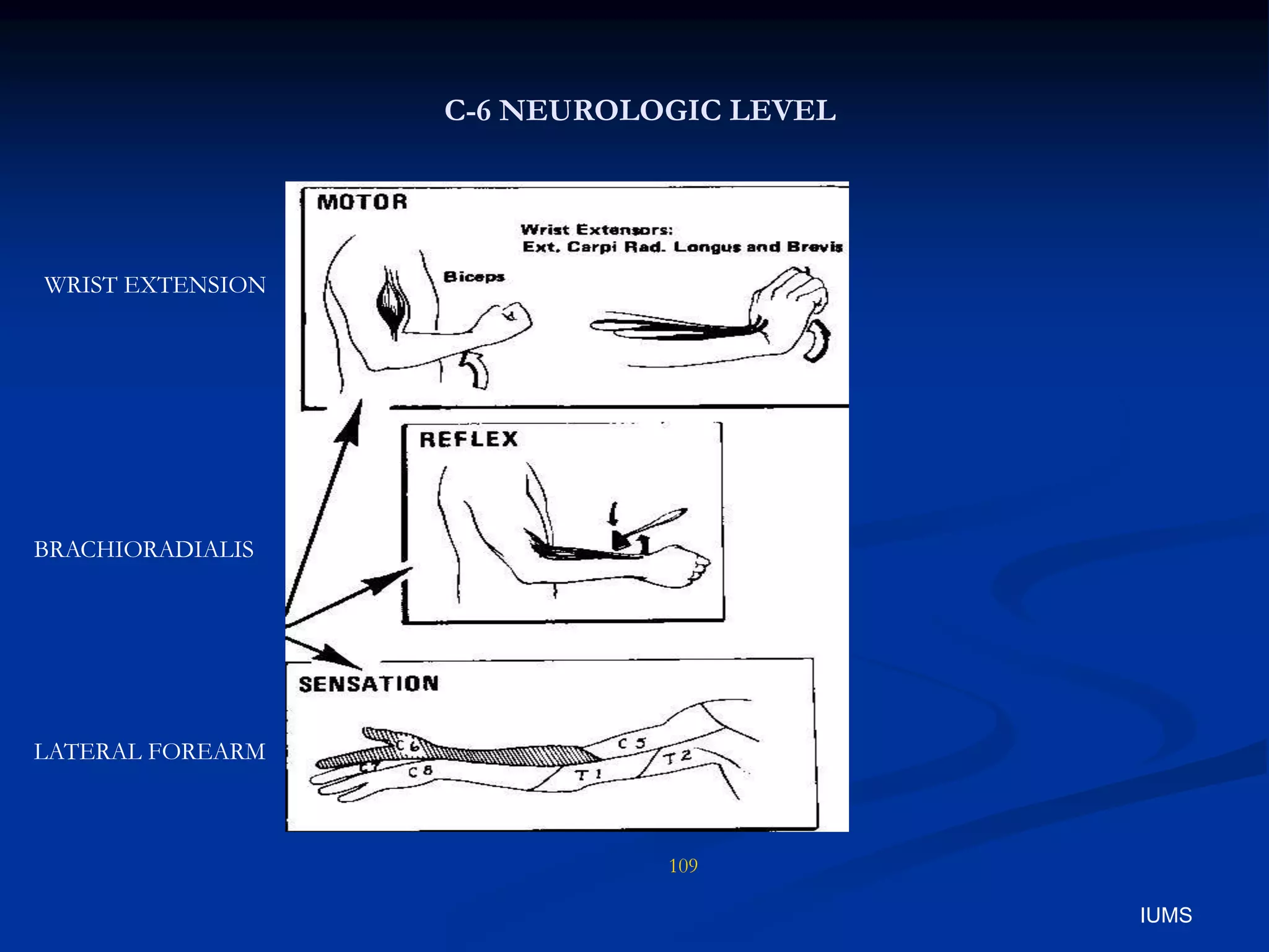 C-6 NEUROLOGIC LEVEL
WRIST EXTENSION
BRACHIORADIALIS
LATERAL FOREARM
109
IUMS
 