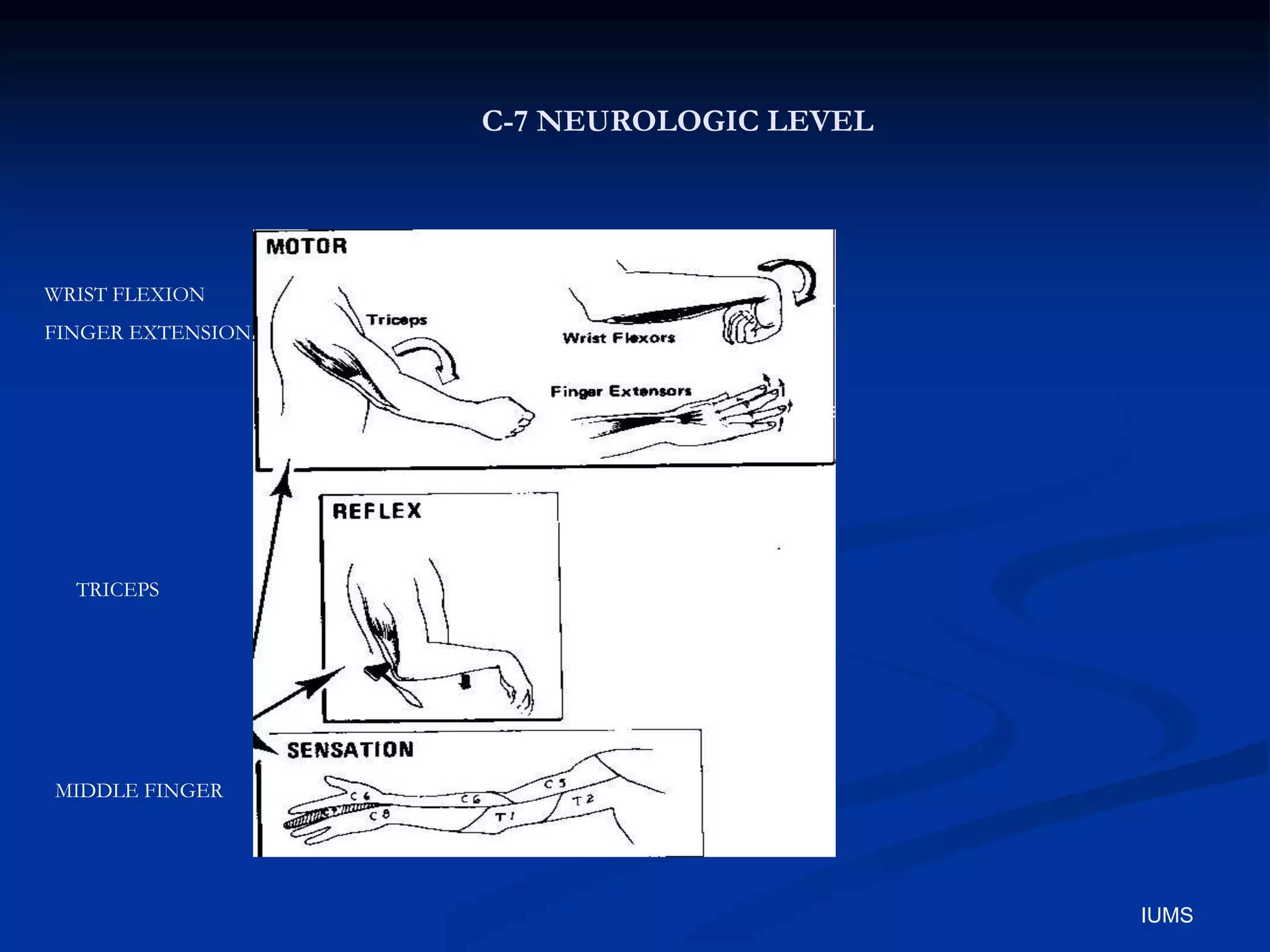 C-7 NEUROLOGIC LEVEL
WRIST FLEXION
FINGER EXTENSION
TRICEPS
MIDDLE FINGER
IUMS
 