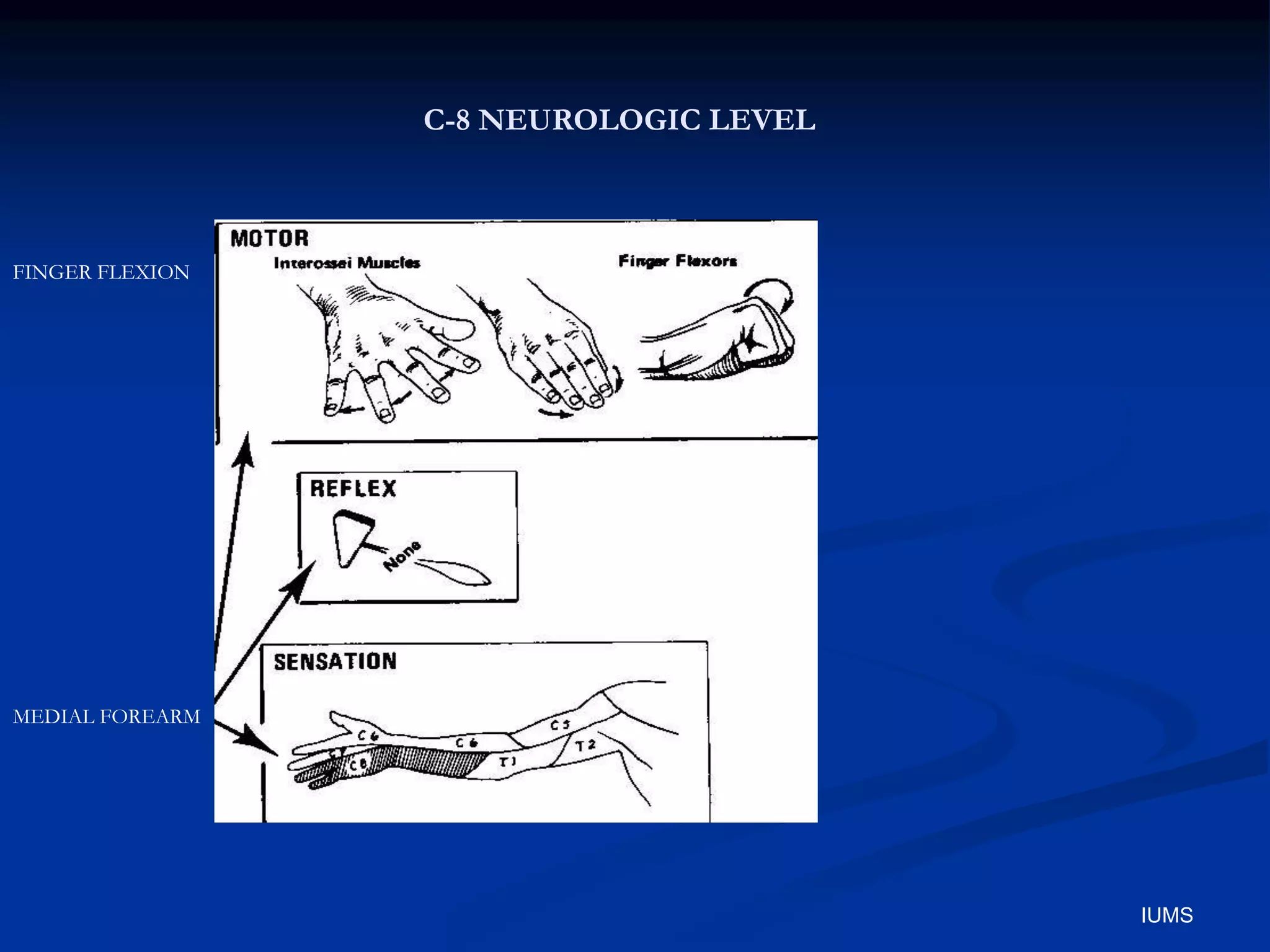 C-8 NEUROLOGIC LEVEL
FINGER FLEXION
MEDIAL FOREARM
IUMS
 