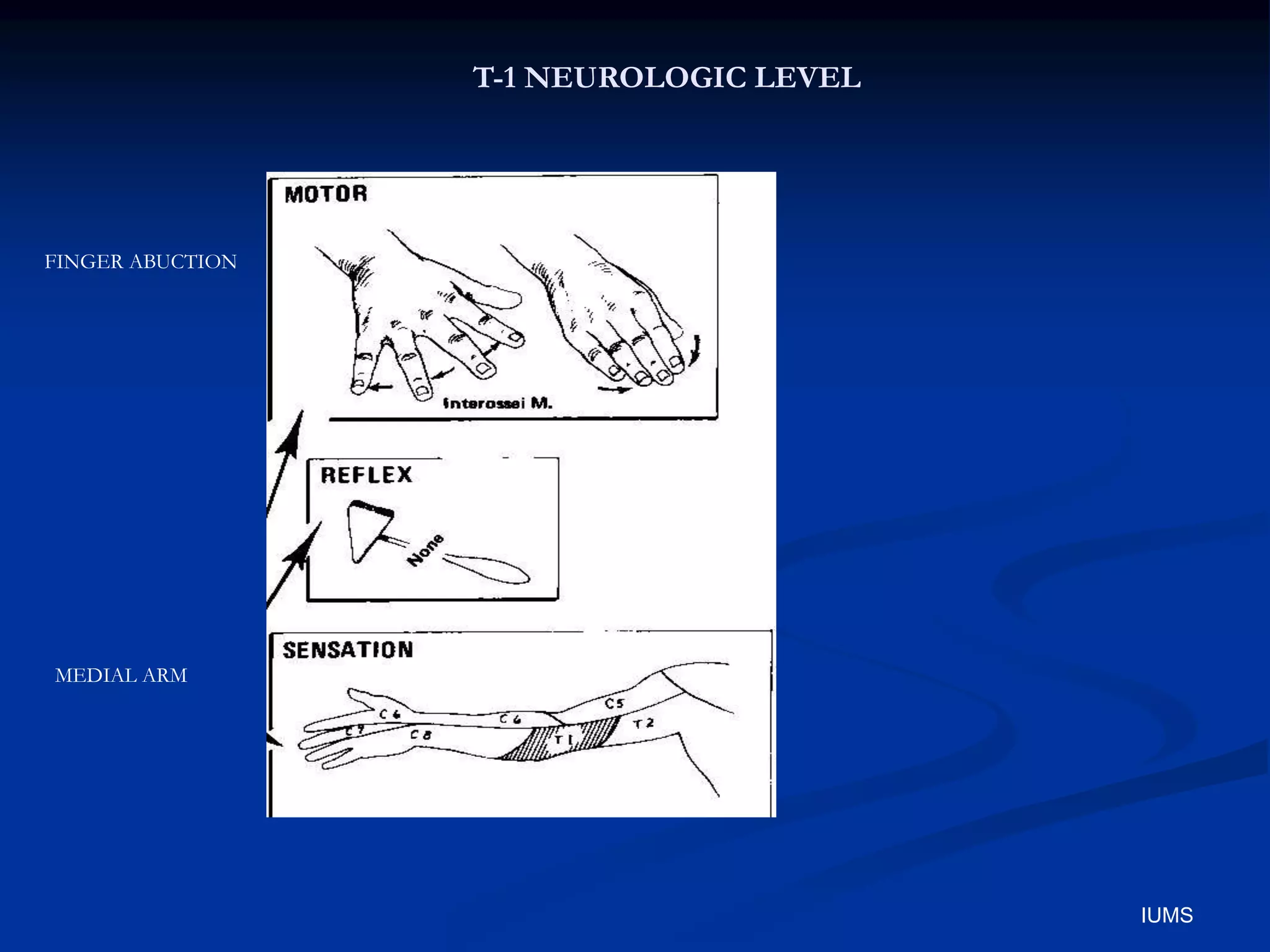 T-1 NEUROLOGIC LEVEL
FINGER ABUCTION
MEDIAL ARM
IUMS
 