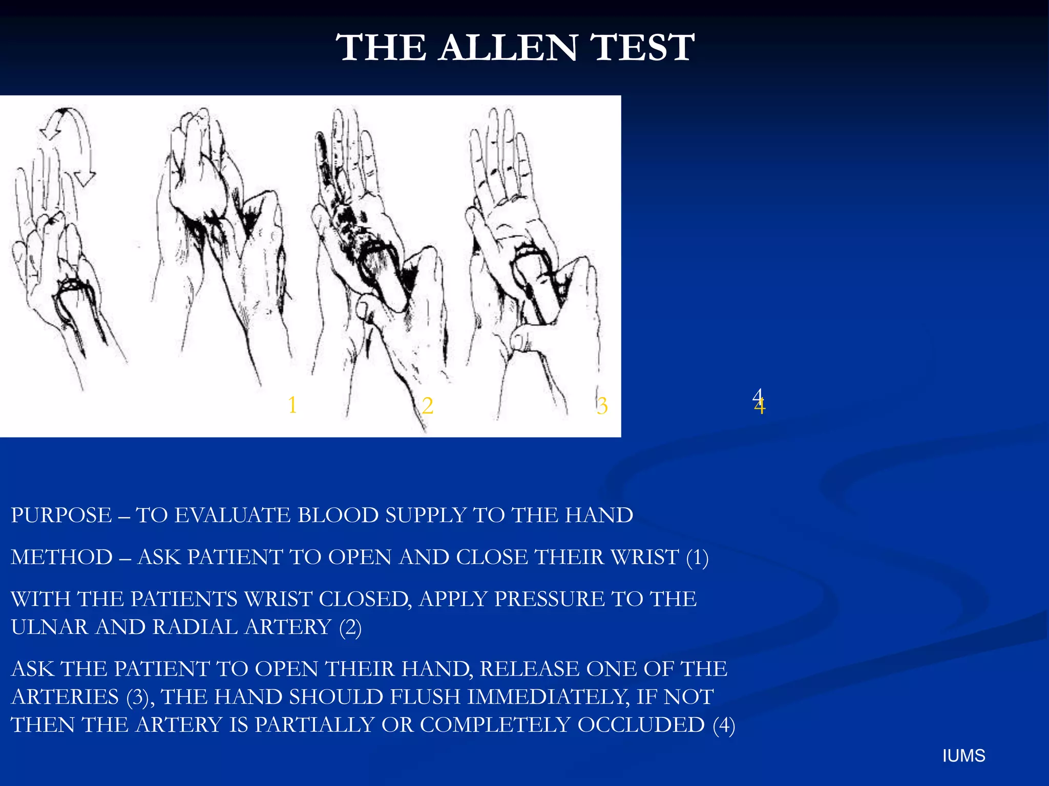 THE ALLEN TEST
PURPOSE – TO EVALUATE BLOOD SUPPLY TO THE HAND
METHOD – ASK PATIENT TO OPEN AND CLOSE THEIR WRIST (1)
WITH THE PATIENTS WRIST CLOSED, APPLY PRESSURE TO THE
ULNAR AND RADIAL ARTERY (2)
ASK THE PATIENT TO OPEN THEIR HAND, RELEASE ONE OF THE
ARTERIES (3), THE HAND SHOULD FLUSH IMMEDIATELY, IF NOT
THEN THE ARTERY IS PARTIALLY OR COMPLETELY OCCLUDED (4)
1 2 3 4
4
IUMS
 
