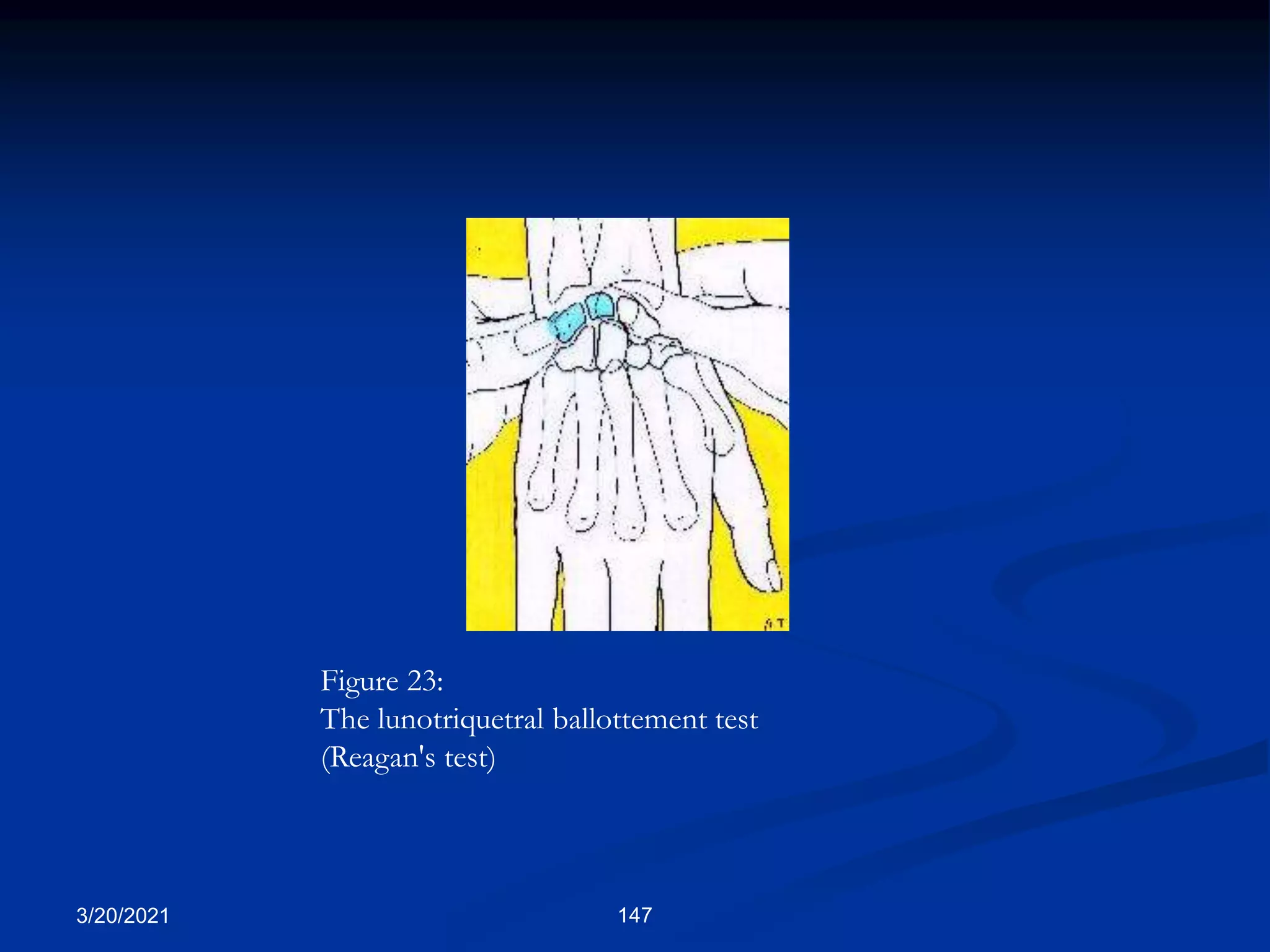 Figure 23:
The lunotriquetral ballottement test
(Reagan's test)
3/20/2021 147
 