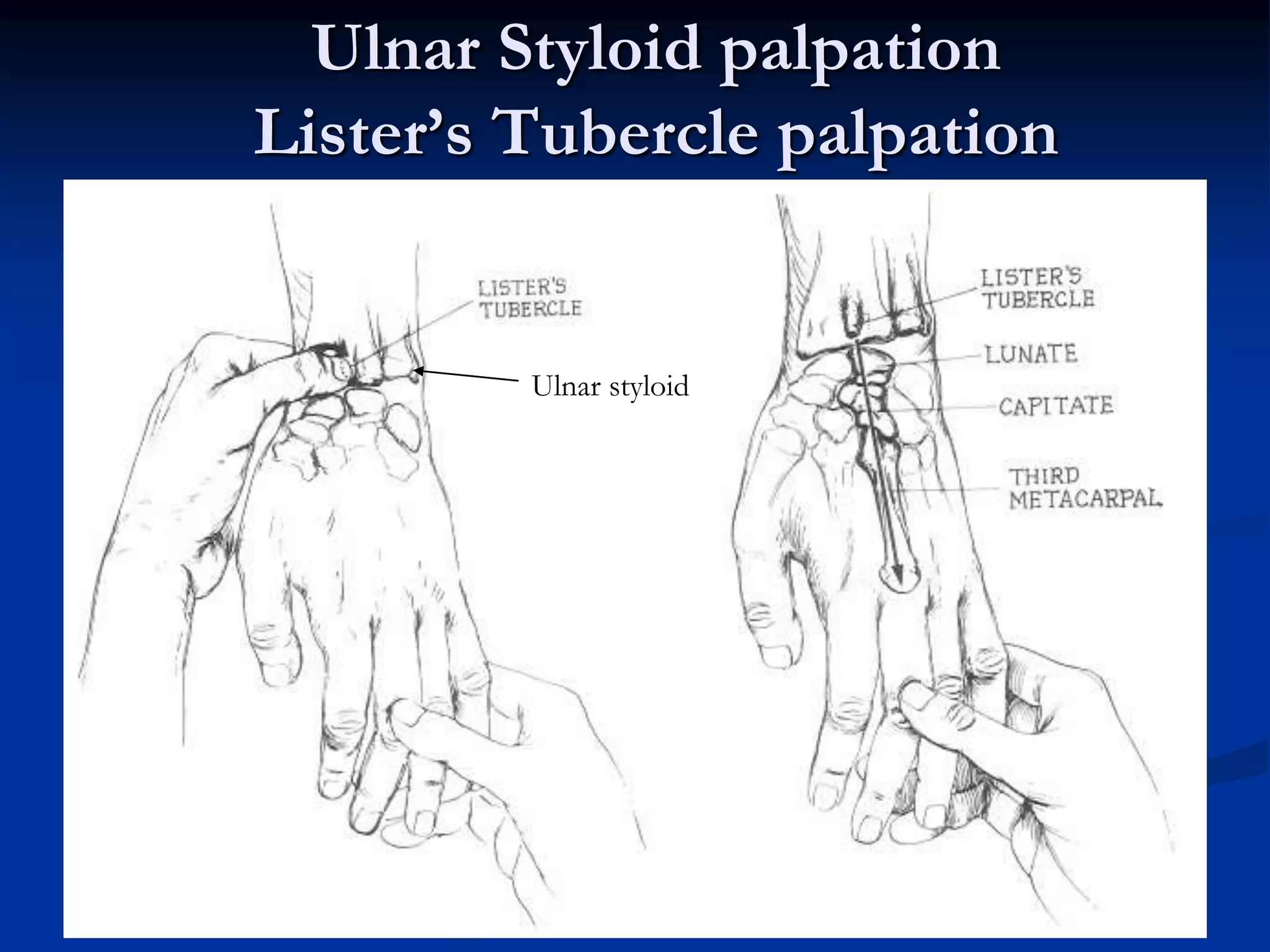 Ulnar Styloid palpation
Lister’s Tubercle palpation
Ulnar styloid
 