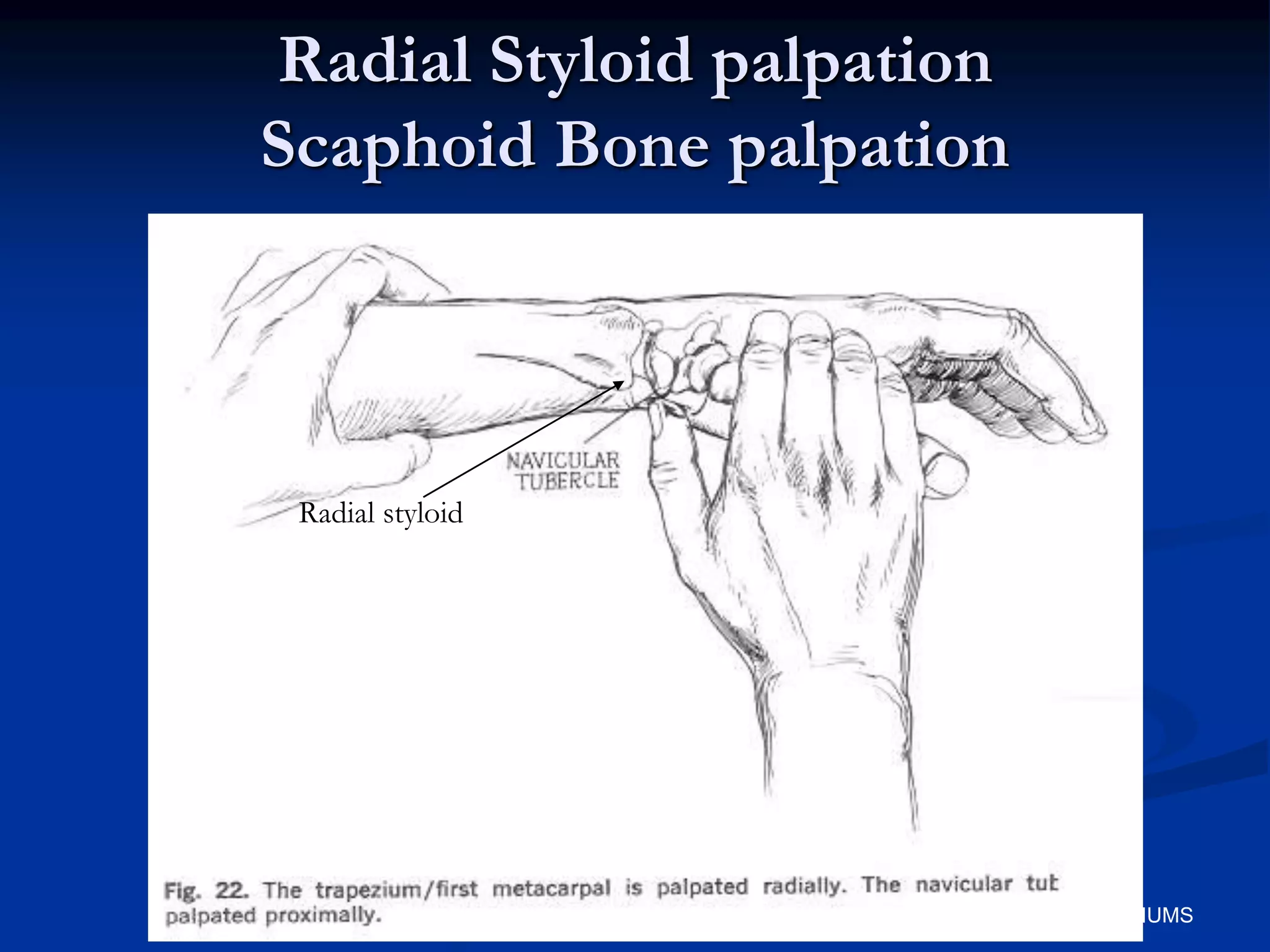 Radial Styloid palpation
Scaphoid Bone palpation
Radial styloid
IUMS
 