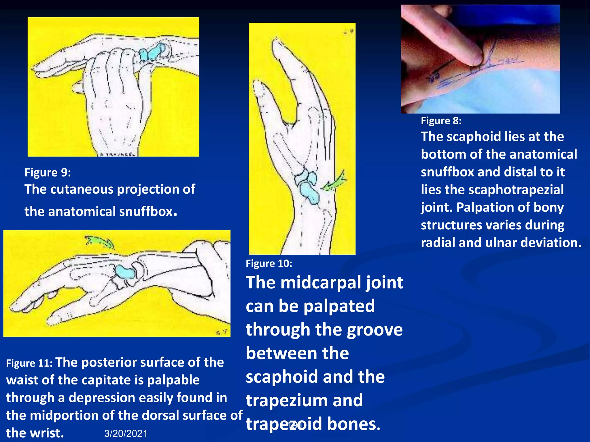 Figure 8:
The scaphoid lies at the
bottom of the anatomical
snuffbox and distal to it
lies the scaphotrapezial
joint. Palpation of bony
structures varies during
radial and ulnar deviation.
Figure 9:
The cutaneous projection of
the anatomical snuffbox.
Figure 10:
The midcarpal joint
can be palpated
through the groove
between the
scaphoid and the
trapezium and
trapezoid bones.
Figure 11: The posterior surface of the
waist of the capitate is palpable
through a depression easily found in
the midportion of the dorsal surface of
the wrist. 3/20/2021
191
 