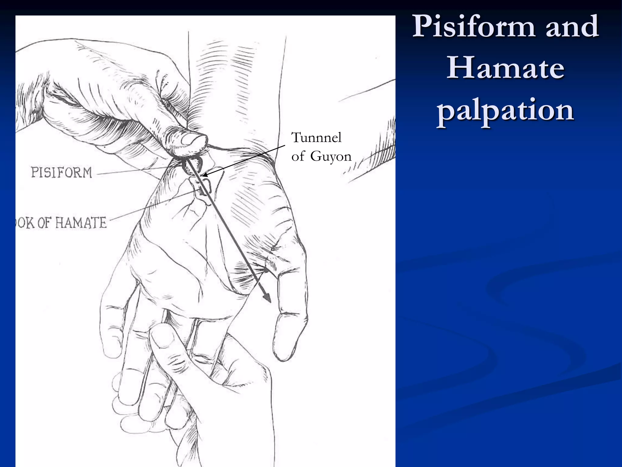 Pisiform and
Hamate
palpation
Tunnnel
of Guyon
 