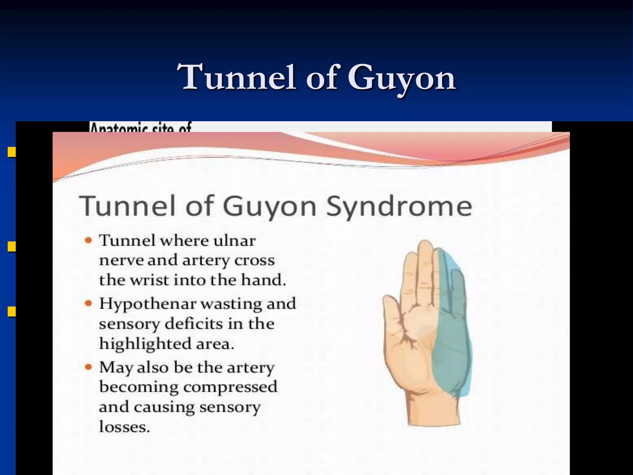 Tunnel of Guyon
 Depression between
pisiform and hook of
hamate
 Contains ulnar nerve
and artery
 Site of compression
injuries
 unusually tender if
pathology is present
IUMS
 