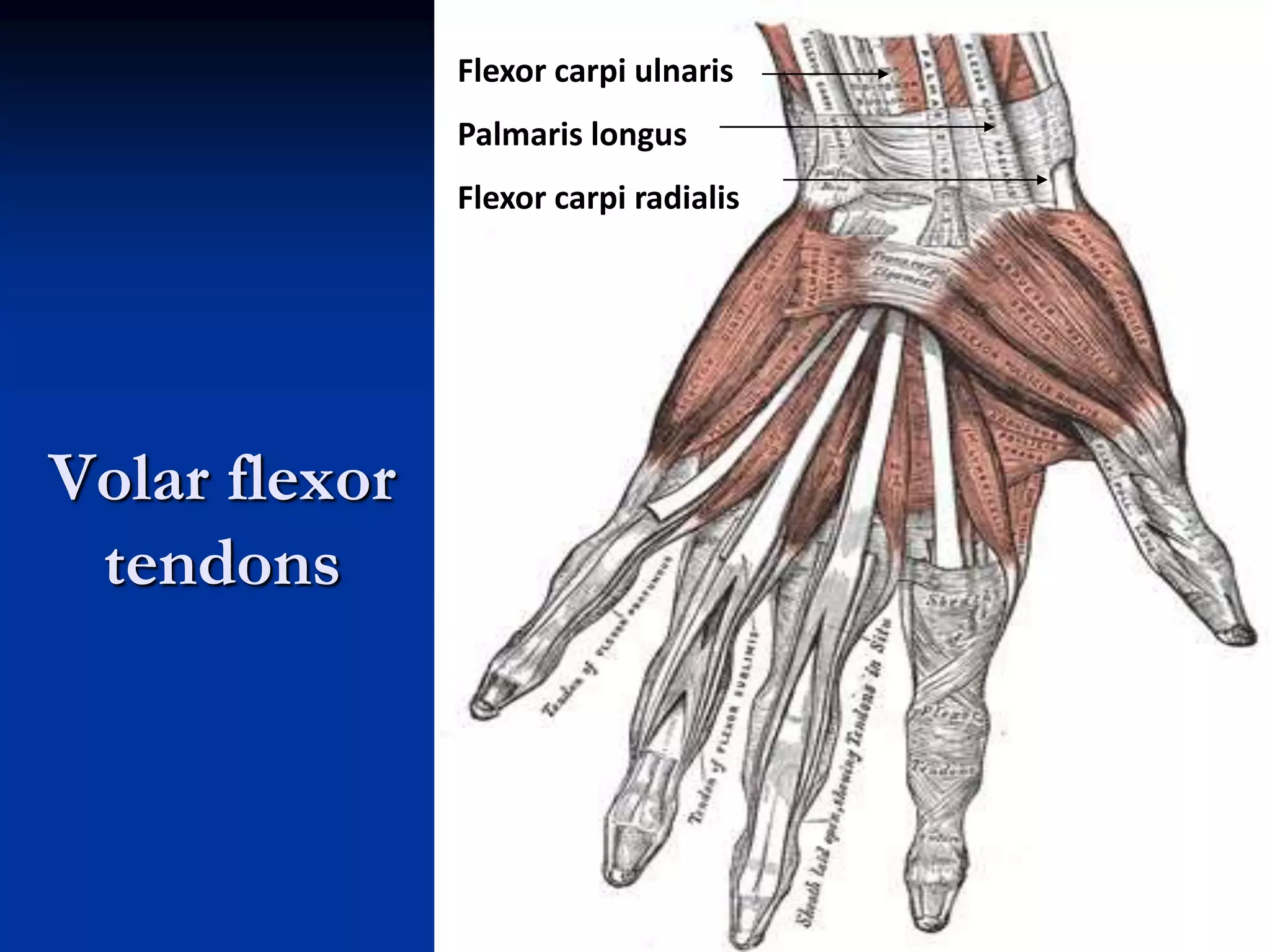 Volar flexor
tendons
Flexor carpi ulnaris
Palmaris longus
Flexor carpi radialis
 