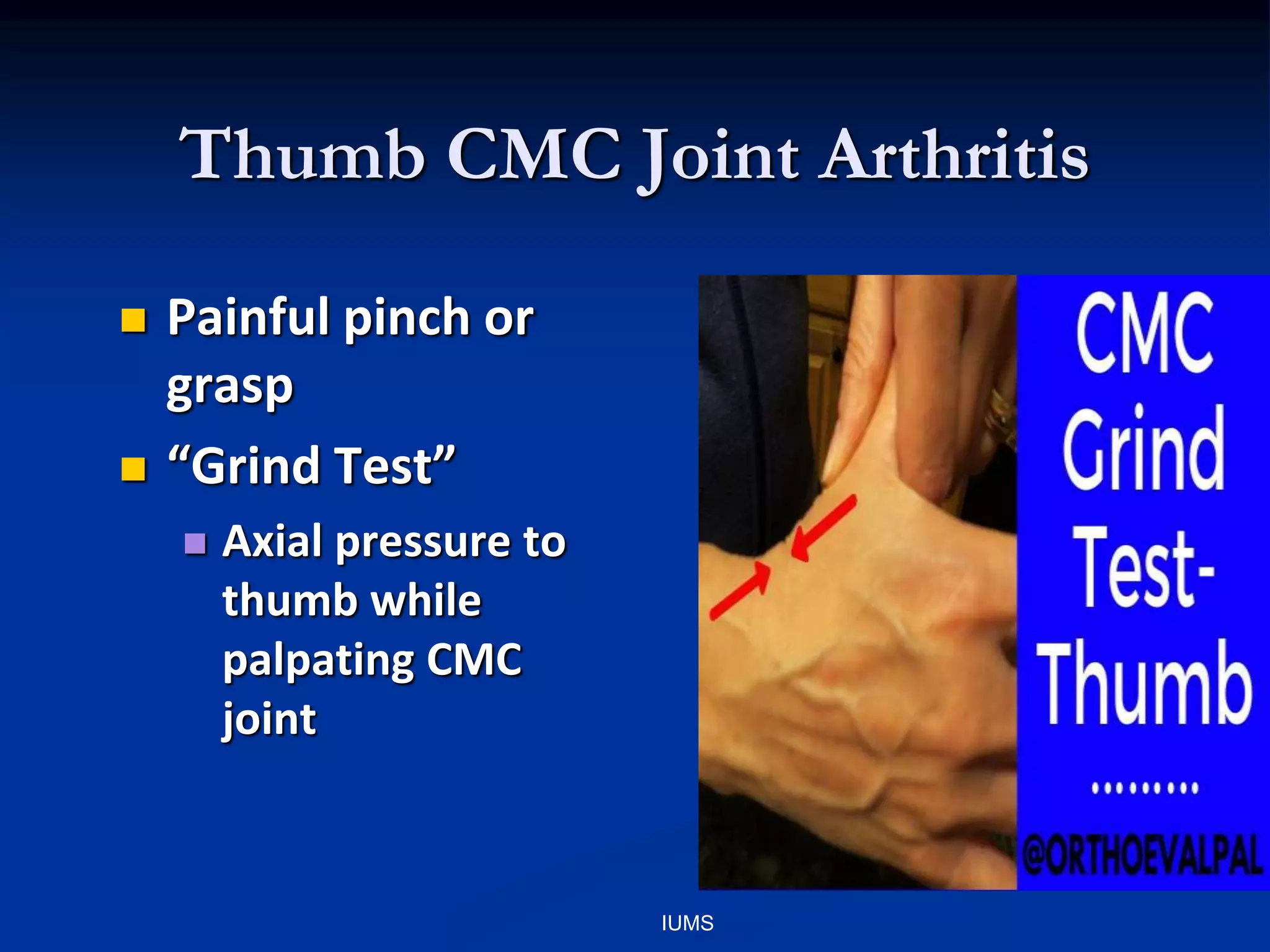 Thumb CMC Joint Arthritis
 Painful pinch or
grasp
 “Grind Test”
 Axial pressure to
thumb while
palpating CMC
joint
IUMS
 