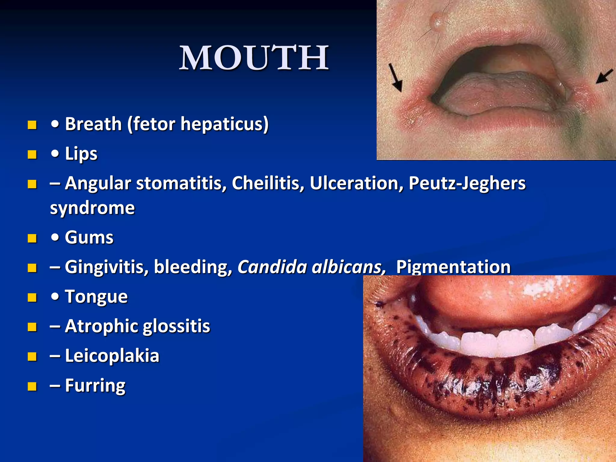 MOUTH
 • Breath (fetor hepaticus)
 • Lips
 – Angular stomatitis, Cheilitis, Ulceration, Peutz-Jeghers
syndrome
 • Gums
 – Gingivitis, bleeding, Candida albicans, Pigmentation
 • Tongue
 – Atrophic glossitis
 – Leicoplakia
 – Furring
 