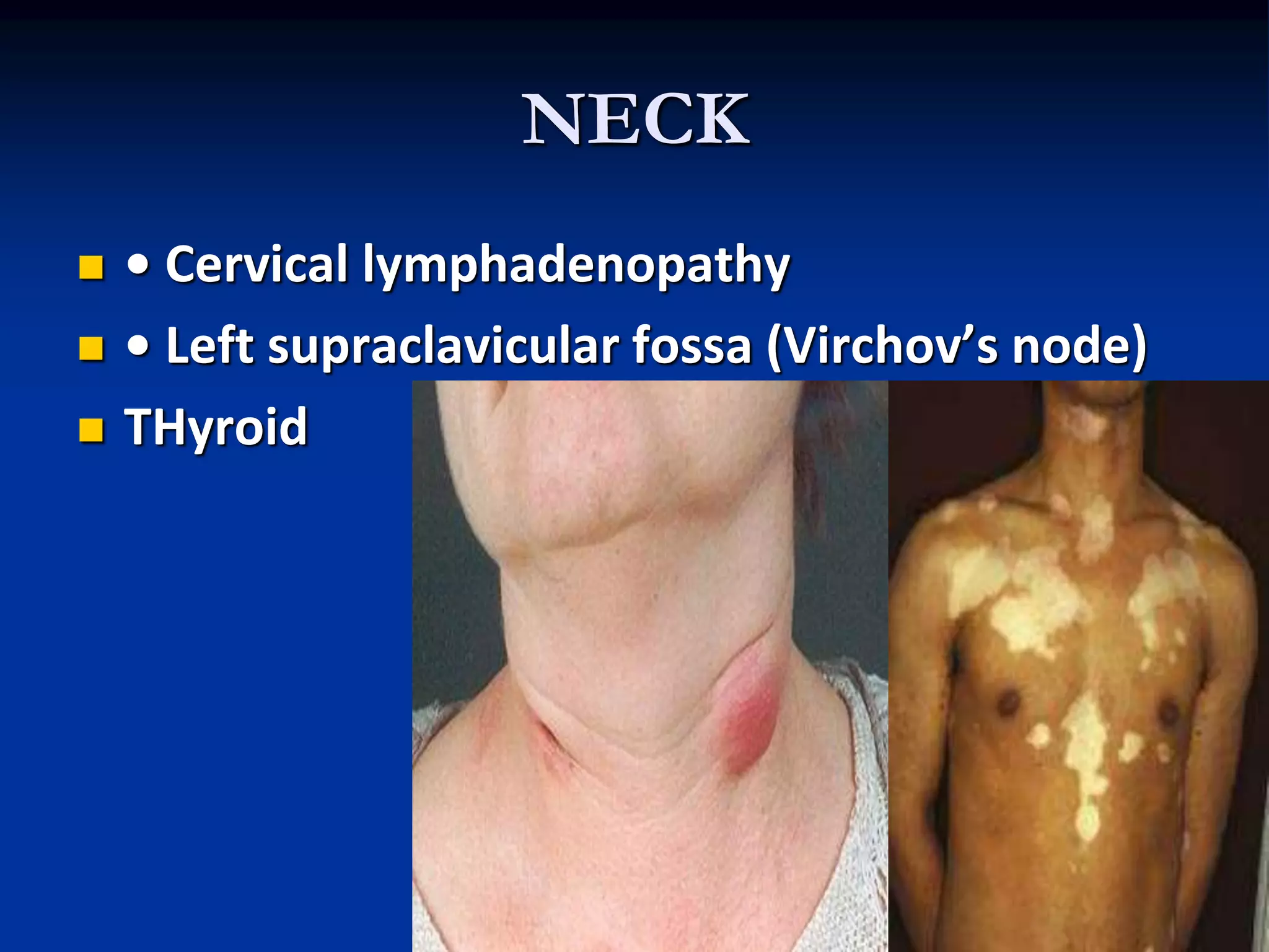 NECK
 • Cervical lymphadenopathy
 • Left supraclavicular fossa (Virchov’s node)
 THyroid
 