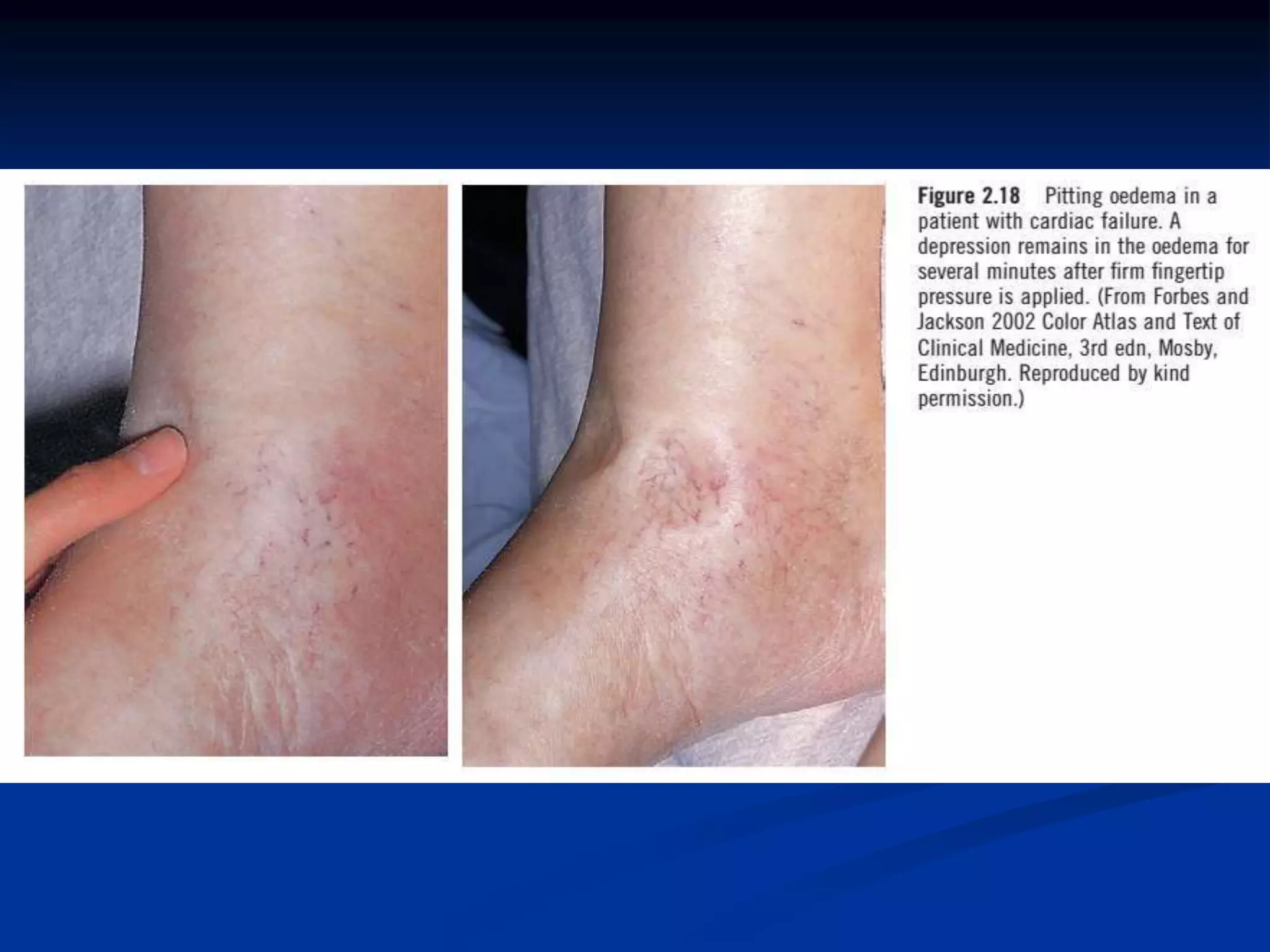 “If people see any redness, blistering or
swelling in the legs, especially if it is
getting worse, they definitely need to see
their doctor.” – Dr. Leslie Gilbert
 