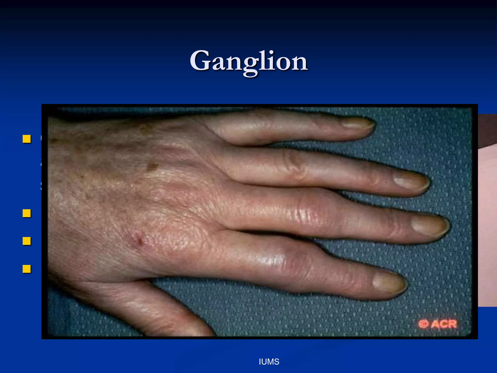 Ganglion
 Cystic structure that
arises from synovial
sheath
 Discrete mass
 Dull ache
 Dorsal or Volar aspect
IUMS
 