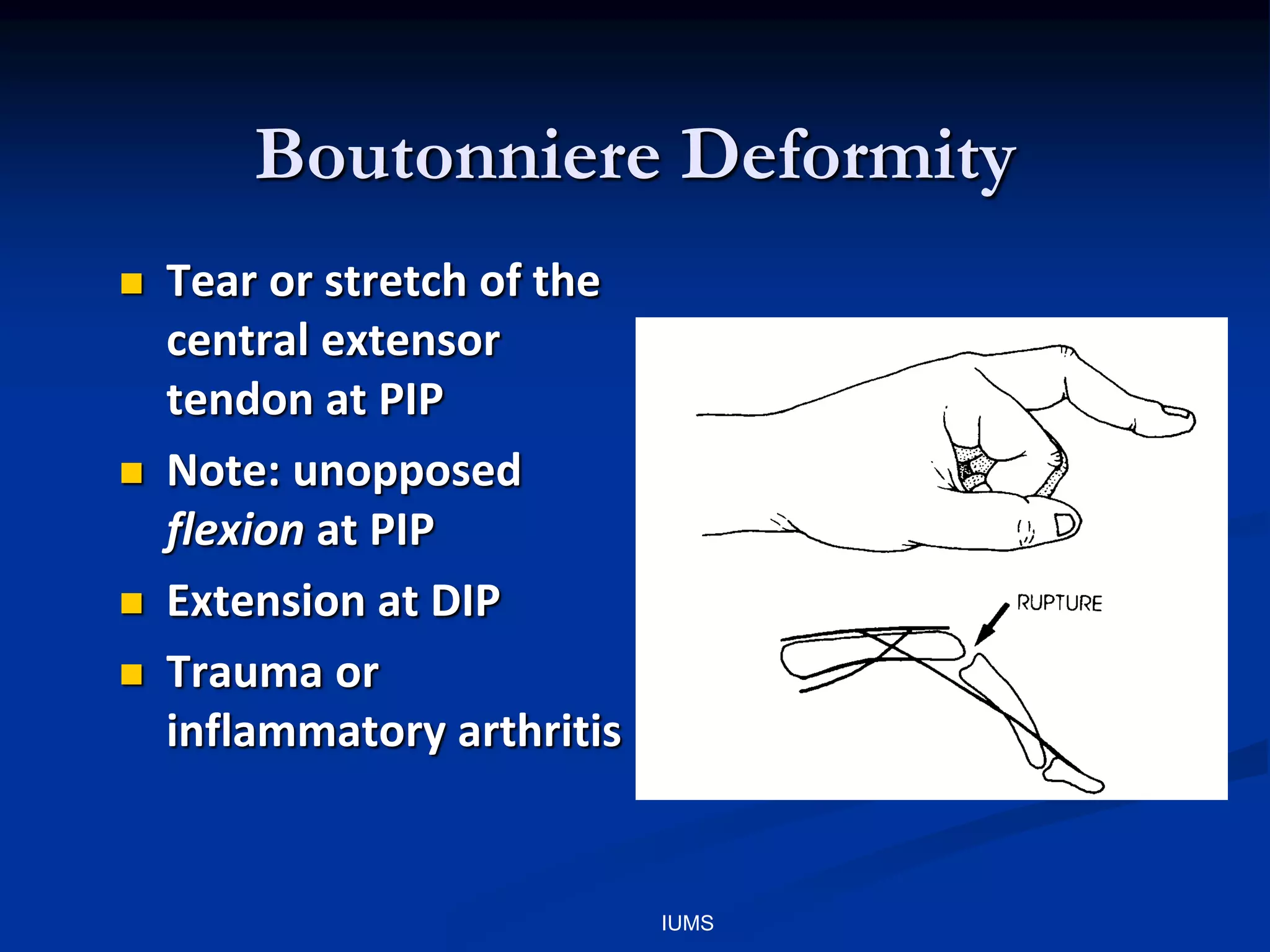 Boutonniere Deformity
 Tear or stretch of the
central extensor
tendon at PIP
 Note: unopposed
flexion at PIP
 Extension at DIP
 Trauma or
inflammatory arthritis
IUMS
 