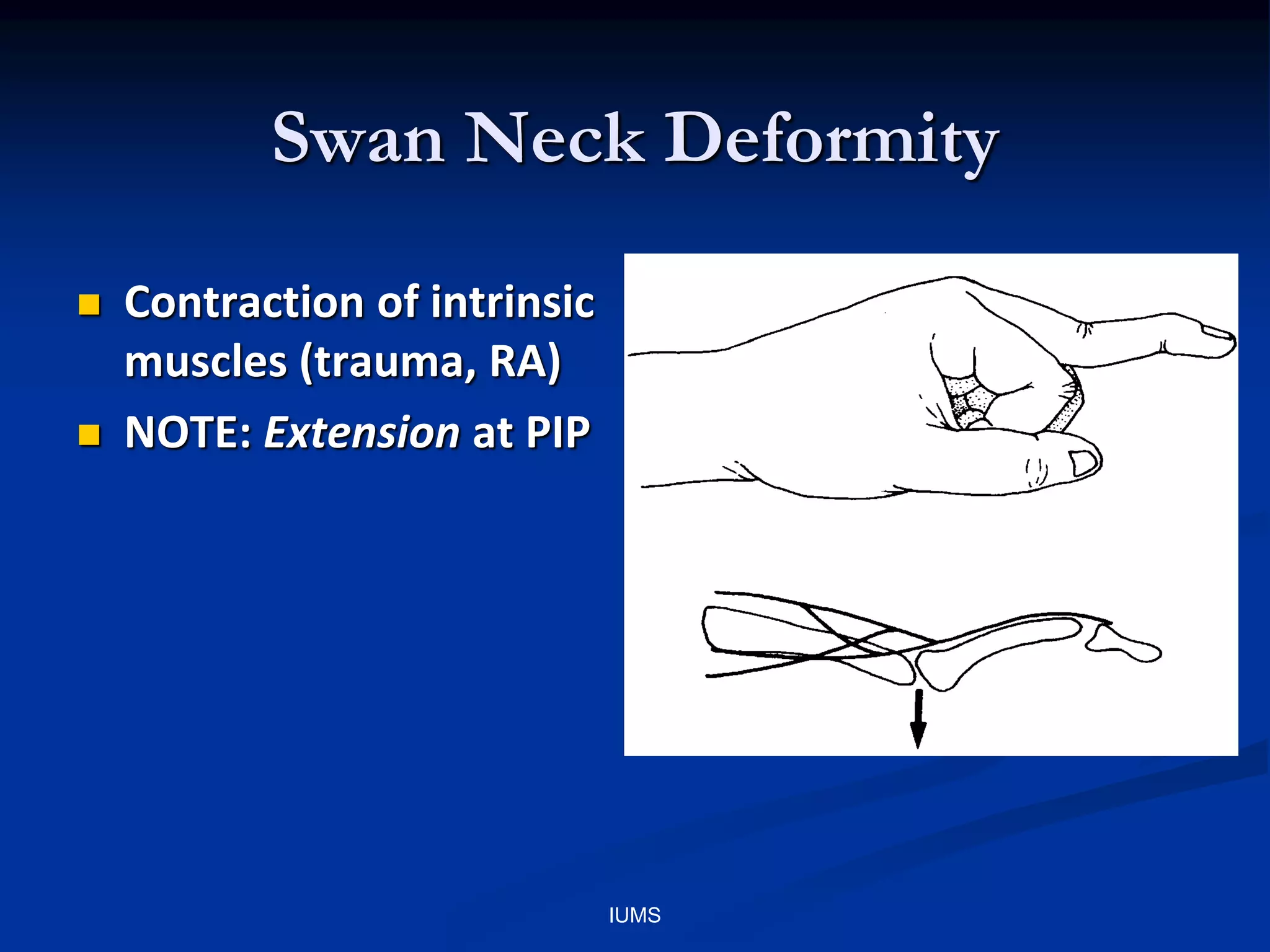 Swan Neck Deformity
 Contraction of intrinsic
muscles (trauma, RA)
 NOTE: Extension at PIP
IUMS
 