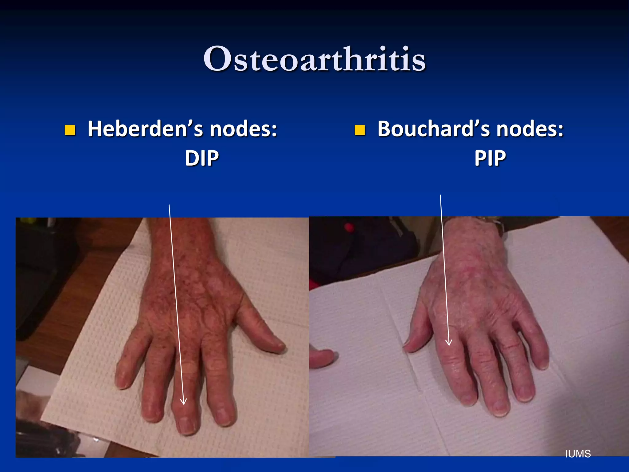 Osteoarthritis
 Heberden’s nodes:
DIP
 Bouchard’s nodes:
PIP
IUMS
 