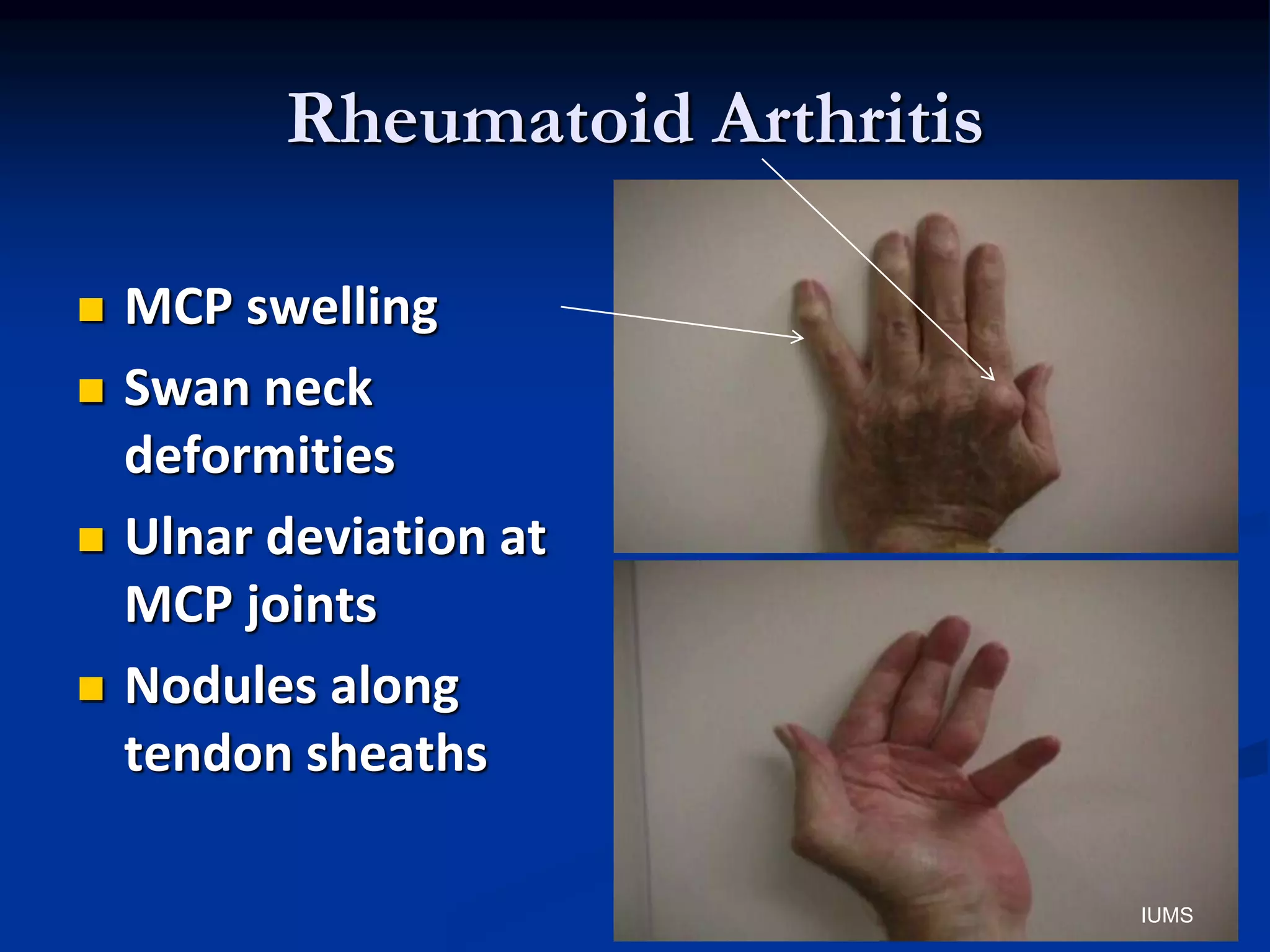 Rheumatoid Arthritis
 MCP swelling
 Swan neck
deformities
 Ulnar deviation at
MCP joints
 Nodules along
tendon sheaths
IUMS
 