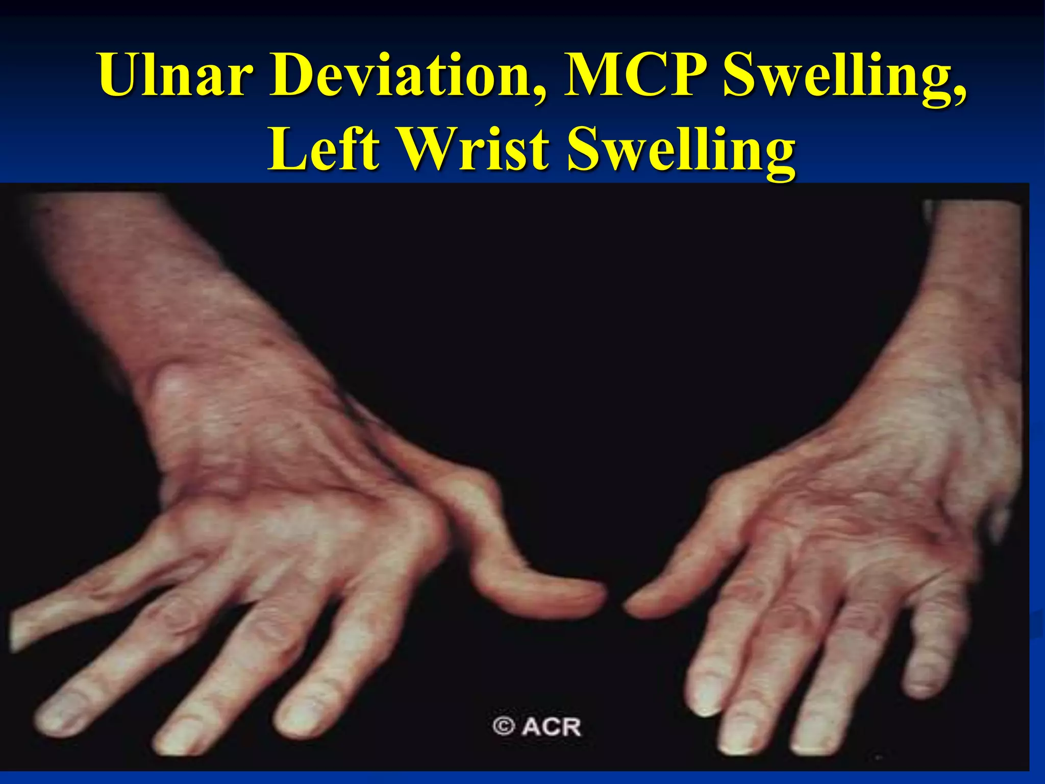 Ulnar Deviation, MCP Swelling,
Left Wrist Swelling
 