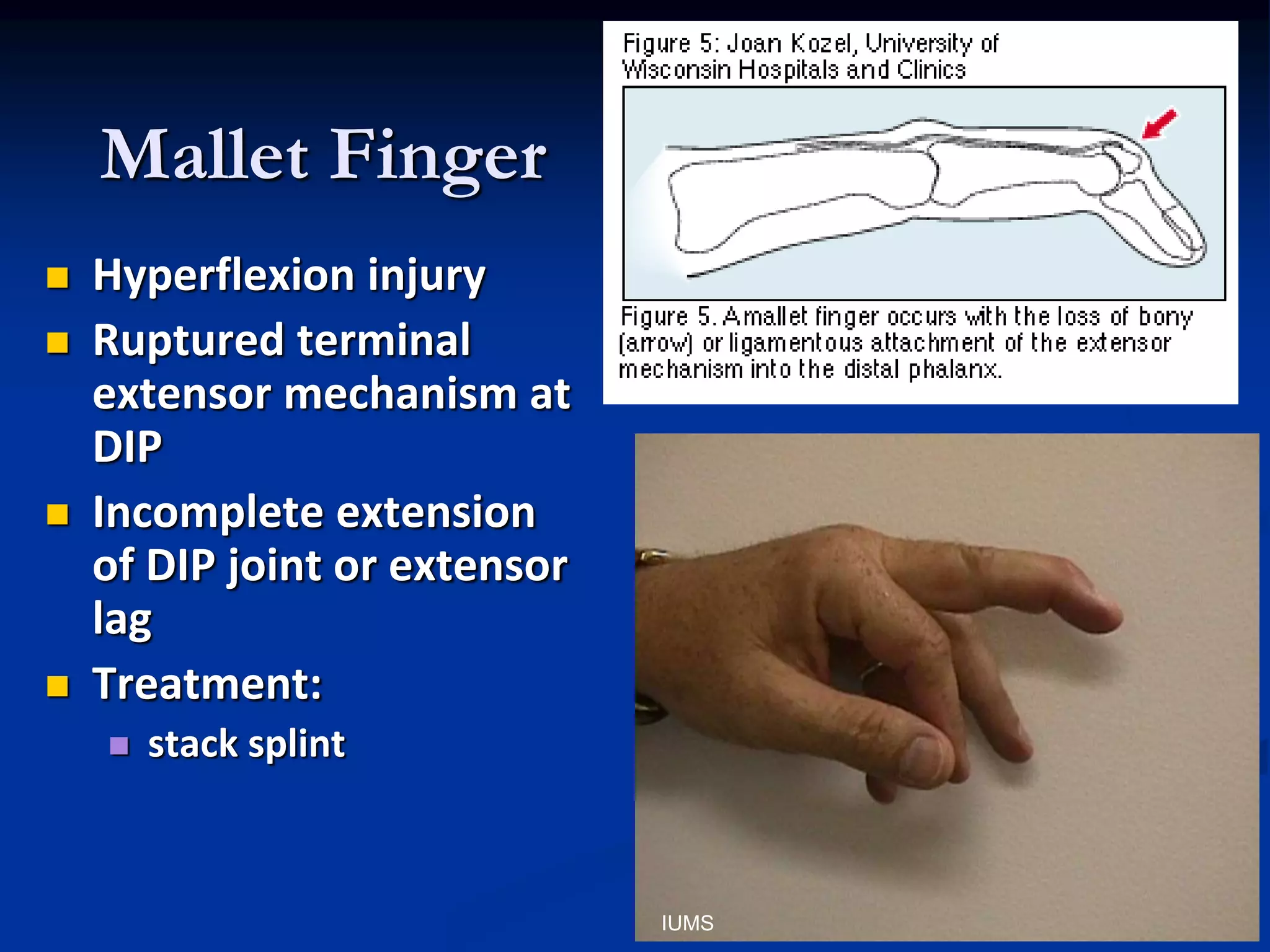 Mallet Finger
 Hyperflexion injury
 Ruptured terminal
extensor mechanism at
DIP
 Incomplete extension
of DIP joint or extensor
lag
 Treatment:
 stack splint
IUMS
 