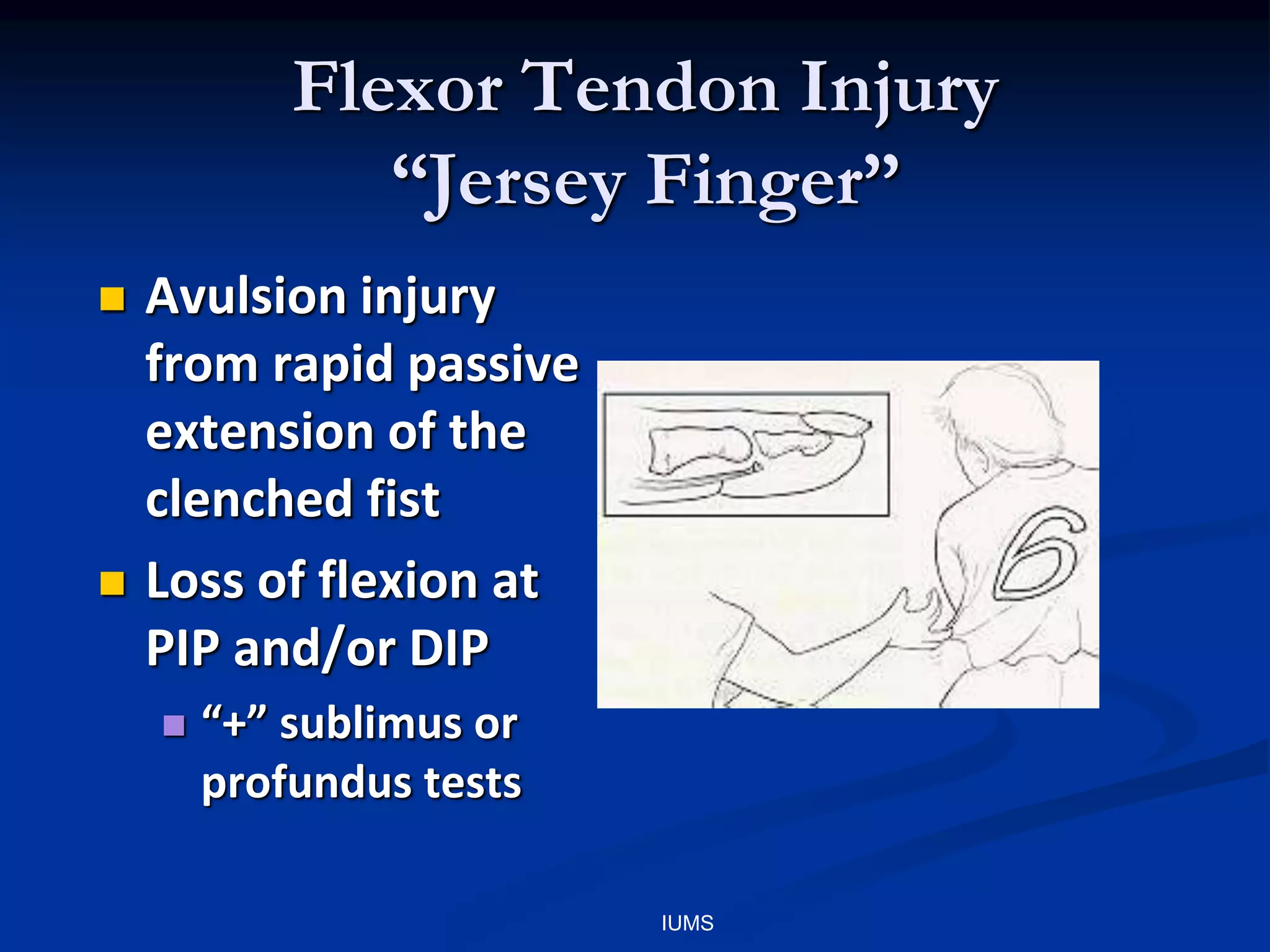 Flexor Tendon Injury
“Jersey Finger”
 Avulsion injury
from rapid passive
extension of the
clenched fist
 Loss of flexion at
PIP and/or DIP
 “+” sublimus or
profundus tests
IUMS
 