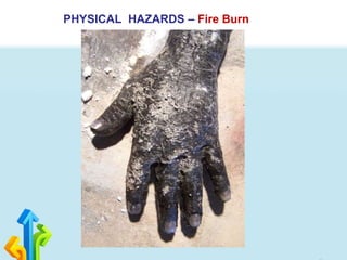 PHYSICAL HAZARDS – Fire Burn
 