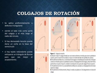 COLGAJOS DE ROTACIÓN
• Se aplica preferentemente a
defectos triangulares
• siendo el lado más corto parte
del colgajo y el más largo el
radio del círculo.
• Si hay demasiada tensión puede
darse un corte en la base del
semicírculo
• si hay tejido redundante puede
extirparse un triángulo de Burow
para que sea mejor el
acoplamiento.
•
 