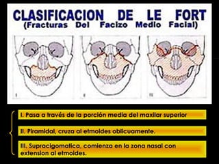 I. Pasa a través de la porción media del maxilar superior
II. Piramidal, cruza al etmoides oblicuamente.
III. Supracigomatica, comienza en la zona nasal con
extension al etmoides.
 
