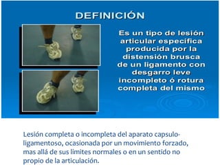Lesión completa o incompleta del aparato capsulo-
ligamentoso, ocasionada por un movimiento forzado,
mas allá de sus limites normales o en un sentido no
propio de la articulación.
Esguinces
 