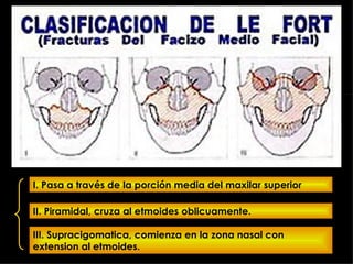 I. Pasa a través de la porción media del maxilar superior II. Piramidal, cruza al etmoides oblicuamente. III. Supracigomatica, comienza en la zona nasal con extension al etmoides. 