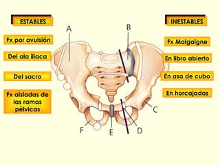 ESTABLES INESTABLES Fx Malgaigne En libro abierto En asa de cubo En horcajadas Fx por avulsión Del ala iliaca Del sacro Fx aisladas de las ramas pélvicas 
