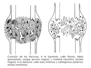Curación de las fracturas. A la izquierda, callo fibroso: tejido   granulatorio, sangre (puntos negros) y material necrótico (óvalos negros). A la derecha, callo óseo (interno) y cartilaginoso (externo), ambos transitorios.                                                         