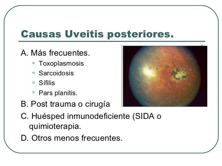 Uveitis Un Reto Para El Internista