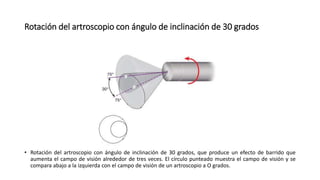Rotación del artroscopio con ángulo de inclinación de 30 grados
• Rotación del artroscopio con ángulo de inclinación de 30 grados, que produce un efecto de barrido que
aumenta el campo de visión alrededor de tres veces. El círculo punteado muestra el campo de visión y se
compara abajo a la izquierda con el campo de visión de un artroscopio a O grados.
 
