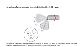 Rotación del artroscopio con ángulo de inclinación de 70 grados
Rotación del artroscopio con ángulo de inclinación de 70 grados. Éste barre un círculo más amplio, pero crea
una zona ciega directamente por delante del mismo en la que no se puede ver nada.
 