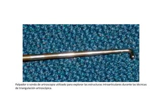 Palpador o sonda de artroscopia utilizado para explorar las estructuras intraarticulares durante las técnicas
de triangulación artroscópica.
 