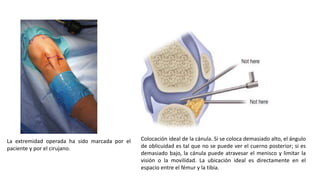 La extremidad operada ha sido marcada por el
paciente y por el cirujano.
Colocación ideal de la cánula. Si se coloca demasiado alto, el ángulo
de oblicuidad es tal que no se puede ver el cuerno posterior; si es
demasiado bajo, la cánula puede atravesar el menisco y limitar la
visión o la movilidad. La ubicación ideal es directamente en el
espacio entre el fémur y la tibia.
 